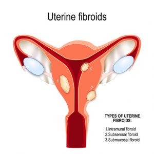uterine fibroid treatment Kansas City Missouri